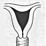 Нормальное раскрытие шейки матки. Рубцовая деформация наружного зева шейки матки. Форма матки у рожавшей. Форма матки у рожавшей. Двурогая матка грушевидная.